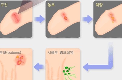 남자 성병 증상] [남자 성병 사진] [남자 성병 종류]