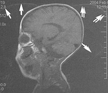 Mri Artifact - Wikipedia