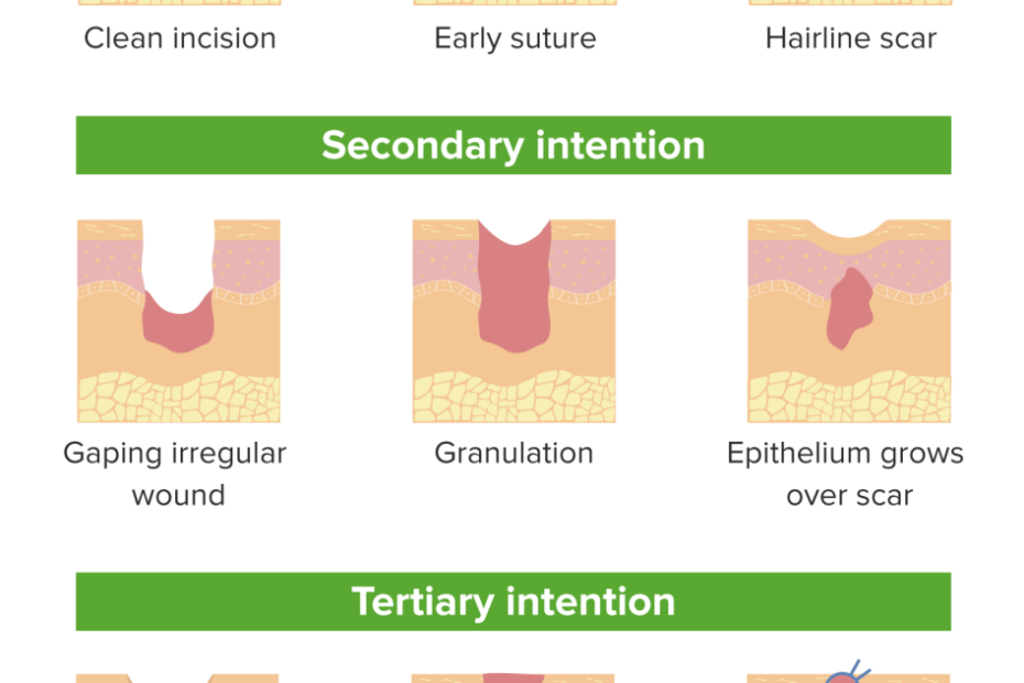 Wound Healing | Concise Medical Knowledge