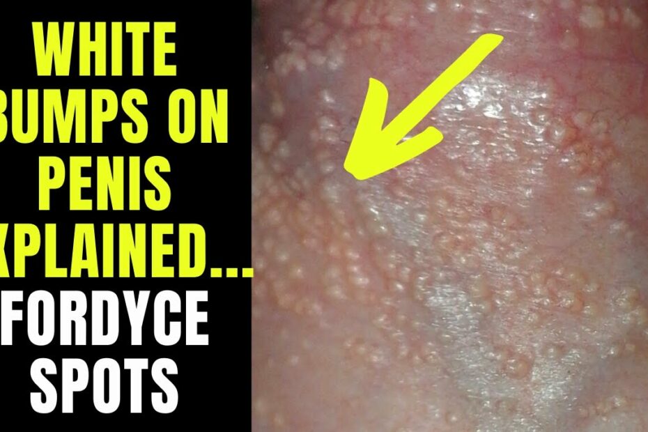 Doctor Explains Fordyce Spots / Granules - Small White Spots Or Pimples On  The Penis... - Youtube