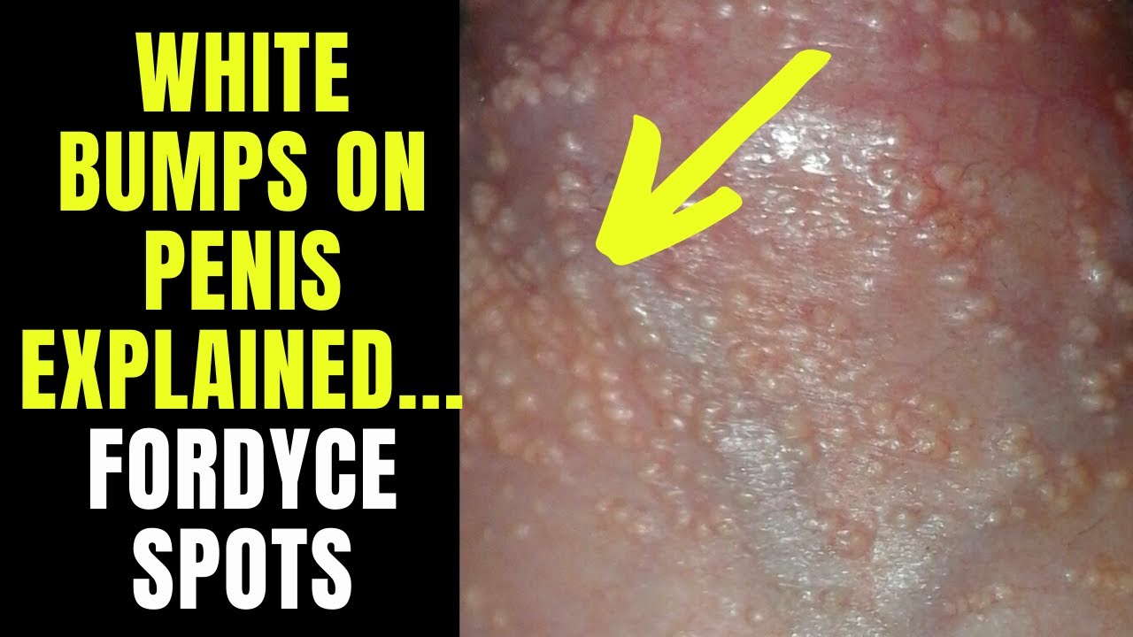 Doctor Explains Fordyce Spots / Granules - Small White Spots Or Pimples On  The Penis... - Youtube