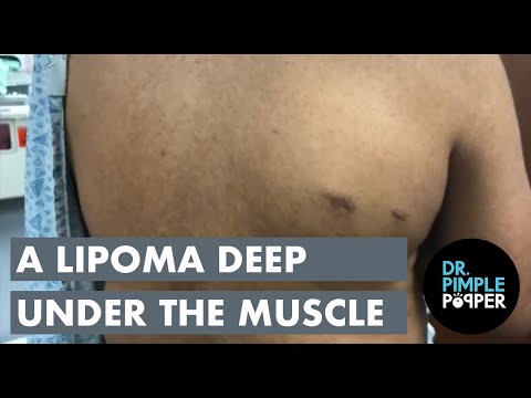 A Lipoma Deep Under The Muscle