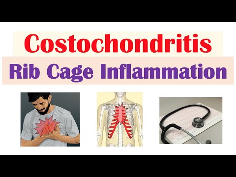 Costochondritis (ontsteking van de ribbenkast) | Oorzaken, symptomen, diagnose, behandeling